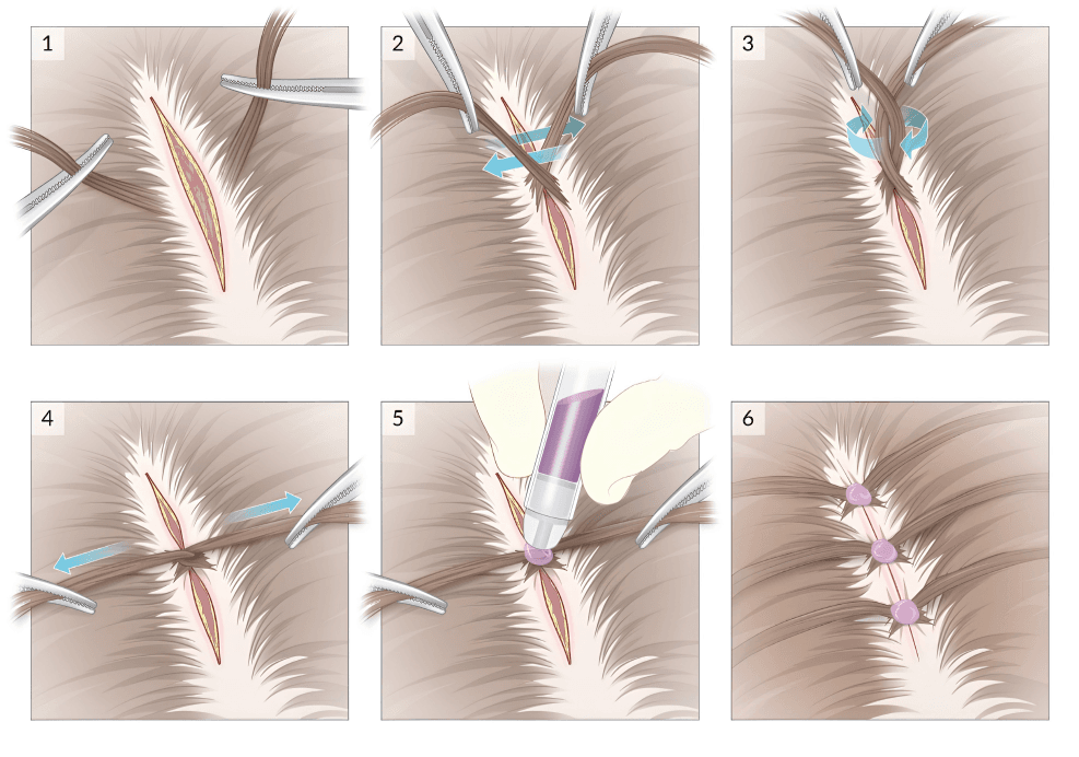 Medical illustration showing the hair-tie technique used to close a scalp laceration by twisting and securing hair across the wound.