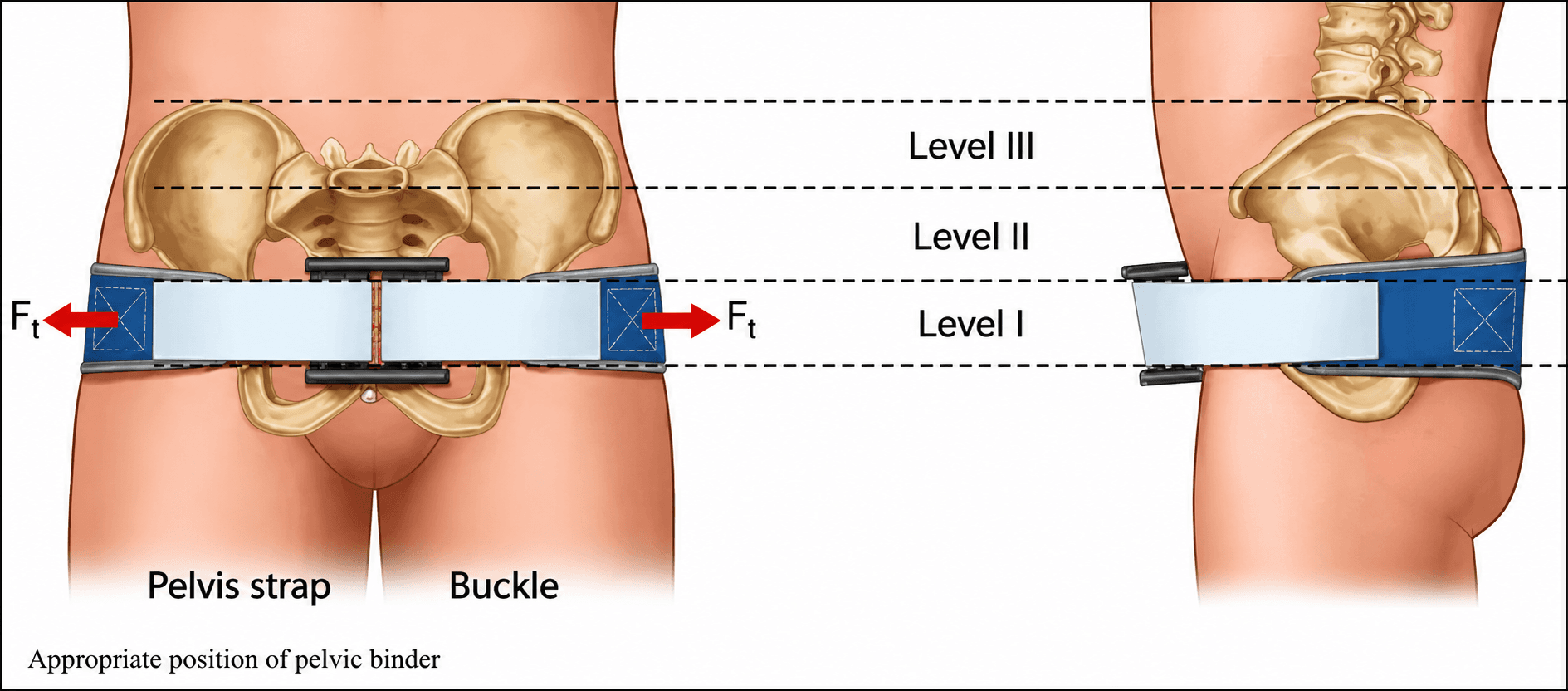 Medical illustration showing the correct placement of a pelvic binder around the pelvis at the level of the greater trochanters, with anterior and lateral views, tension arrows, and anatomical reference levels I–III.